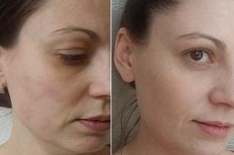 Best Full Body Skin Lightening Treatment Cost Dubai & Abu Dhabi