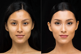 Best Glutathione Injection Dosage for Skin Whitening in Dubai