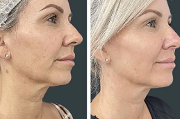 Best HIFU Treatment Cost in Dubai