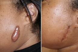Best Keloid Scar Removal Cost in Dubai