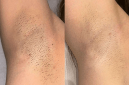 Best Laser Hair Removal by Candela Gentle Max PRODubai & Abu Dhabi - Copy