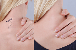 Best Laser Tattoo Removal in Dubai