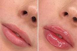 Best Lip Fillers Cost in Dubai