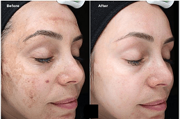 Best Melasma Treatment Cost in Dubai UAE