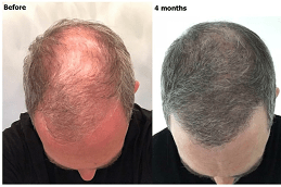 Best PRP Hair Treatment Success Rate Dubai