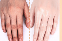 Best Skin Whitening Treatment for Hands Dubai & Abu Dhabi