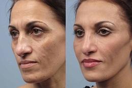 Fractional Co2 Laser Treatment Cost in Dubai & Abu Dhabi