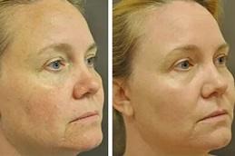 Fractional Co2 Laser Treatment Cost in Dubai UAE