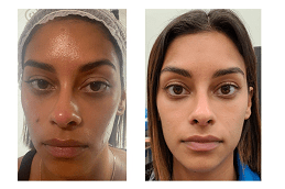 Glutathione Injection Dosage for Skin Whitening in UAE