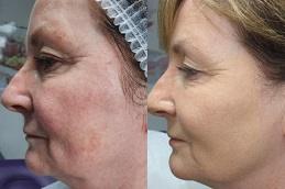 HIFU Treatment Cost in Dubai uae