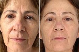 HIFU Treatment Cost in Dubai