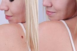 Keloid Scar Removal Cost in Dubai uae