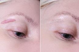 Keloid Scar Removal Cost in Dubai