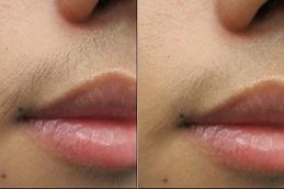 Laser Hair Removal by Candela Gentle Max PRO in Dubai & Abu Dhabi