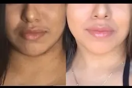 Laser Hair Removal by Candela Gentle Max PRO in Dubai UAE