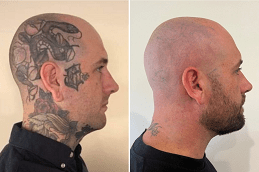 Laser Tattoo Removal in Dubai