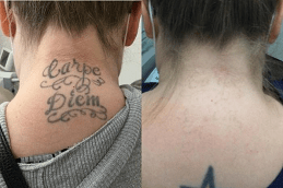 Laser Tattoo Removal in UAE