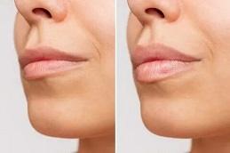 Lip Fillers Cost in Dubai uae