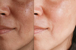 Melasma Treatment Cost in Dubai UAE