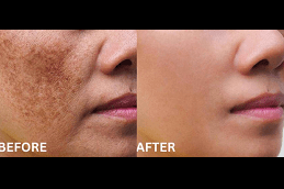 Melasma Treatment Cost in Dubai