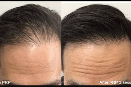 PRP Hair Treatment Success Rate Dubai UAE