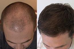 PRP Hair Treatment in Dubai uae