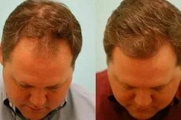 PRP Hair Treatment in Dubai