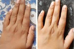 Skin Whitening Treatment for Hands Cost in Dubai UAE