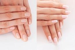 Skin Whitening Treatment for Hands in Dubai & Abu Dhabi