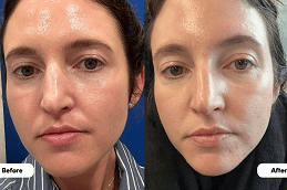 Best HydraFacial Treatment in Dubai