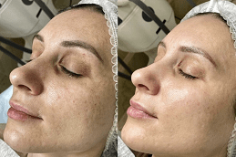 Best Laser Carbon Peel in Dubai
