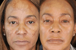 Best Pico Laser Treatment in Dubai