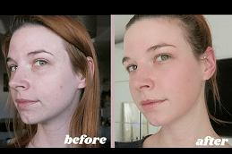 HydraFacial Treatment in Dubai