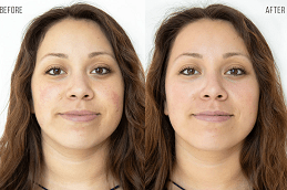 HydraFacial Treatment in UAE Dubai