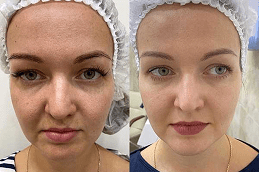 Laser Carbon Peel Cost in Dubai
