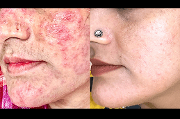 Laser Carbon Peel in Dubai