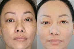 Pico Laser Treatment Cost in Dubai
