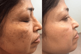 Pico Laser Treatment in Dubai