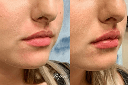 Lip Fillers Injections Cost Dubai