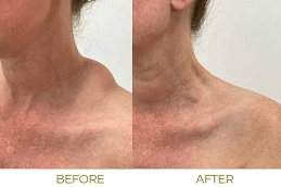 Lipoma Treatment Cost in Dubai