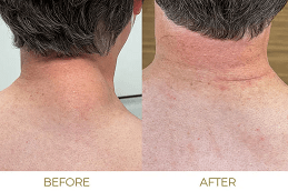 Lipoma Treatment in Dubai