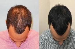 PRP Hair Treatment Cost in Dubai & Abu Dhabi.