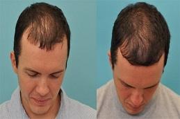 PRP Hair Treatment Cost in Dubai & Abu Dhabi.