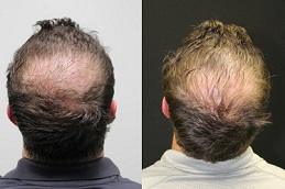 PRP Hair Treatment Cost in Dubai & Abu Dhabi