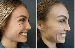Results of Botox Injections in Dubai