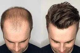 Results of Hair Transplant Treatment Dubai