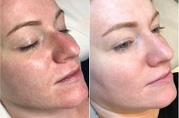 BB Glow Treatment in Dubai Abu Dhabi