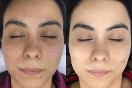 BB Glow Treatment in Dubai UAE