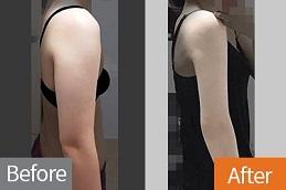 Barbie Arms with Botox Clinic in Dubai Abu-Dhab