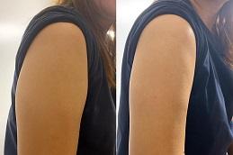 Barbie Arms with Botox Cost in Dubai & Abu-Dhabi